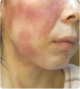 5月のアトピーケアのポイントと対策について アトピー性皮膚炎 総合情報サイト あとぴナビ